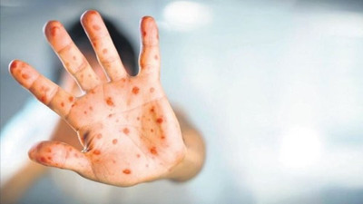 Maymun çiçeği bir ülkeye daha sıçradı