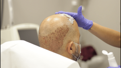 Uzmanından saç ekimiyle ilgili yaz sıcakları uyarısı