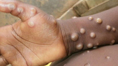 En yetkili ağızdan maymun çiçeği virüsü açıklaması!