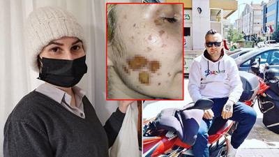Eski sevgili vahşetinde Adli tıp raporu açıklandı. Yüzündeki yaralar…