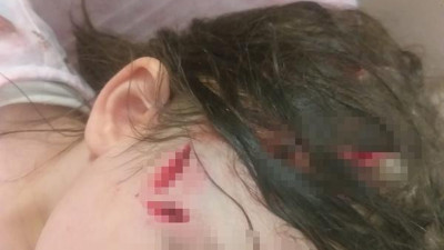 Yine pitbull dehşeti. 6 yaşındaki kız çocuğu ölümden döndü