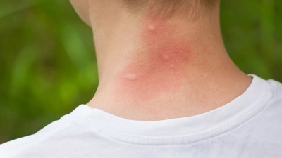 Yazın korkulu rüyası olan sivrisineklerden kurtulmanın yolları neler?