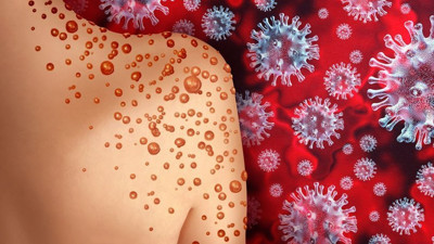 Maymun çiçeği virüsüne vahşi hayvan çözümü