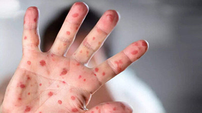 Dünya Sağlık Örgütü Maymun Çiçeği Virüsü vaka sayısını açıkladı. Pandemiye dönüşecek mi?