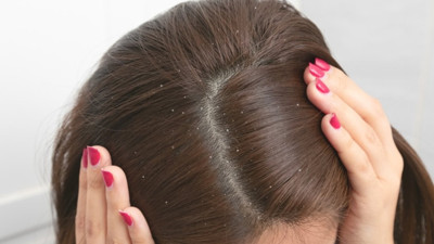 Saç tasarımcısı Zili: Kepekten kurtulmak kolay