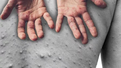 En fazla maymun çiçeği vakasının olduğu yer belli oldu