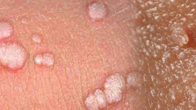 Uzmanı açıkladı: HPV virüsüne dikkat!