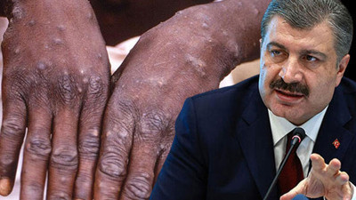 Bakan Koca’dan Maymun çiçeği virüsü açıklaması