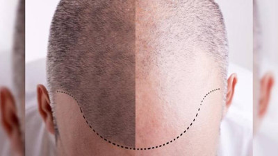 Saç ekim uzmanı Nihat Tüney: Yaz sıcakları saç ekimine engel değil