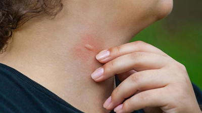 Sivrisinek ısırığına anında etki eden formül. Kaşıntı ve kızarıklık kalmayacak