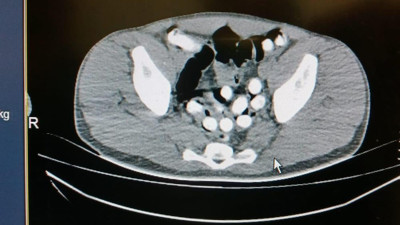 Mide ve bağırsağından çıkanlar şaşkına çevirdi
