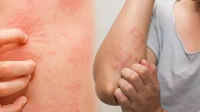 Bunları uygulayın. Korkulu rüyanız haline gelen hastalık bitsin