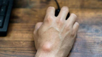 Eliniz böyle görünüyorsa dikkat. Kanser olabilirsiniz