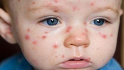 Prof. Güzel: Çocuk alerjilerinde genetik faktörler yüzde 30-50 oranında etkiliyor