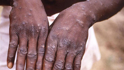 Dünya Sağlık Örgütü’nden flaş Maymun Çiçeği açıklaması