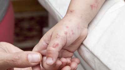 Türkiye'de ilk Maymun Çiçeği görüldü uzmanı uyardı