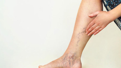 Op. Dr. Alur: Sıcak havalarda varis şikâyetleri artıyor