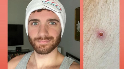 Maymun çiçeğine yakalanan hasta kâbusu anlattı