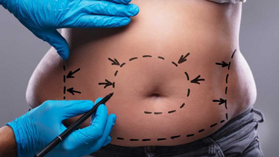 Liposuction zararlı mı?