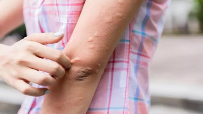 Sivrisinekleri mıknatıs gibi kendinize çekmeyin. Bunu yapanı daha çok ısırıyorlar