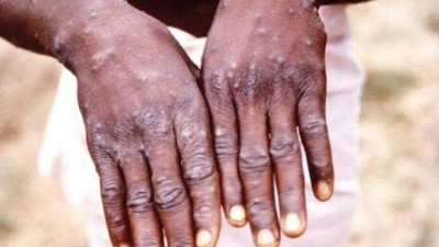 DSÖ: Küresel maymun çiçeği vaka sayısı 10 bine yaklaştı