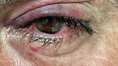 Şişeden gelen tehlike. Gözünüzden olmayın