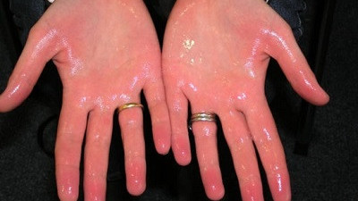 Elleriniz böyle olursa hemen doktora gidin