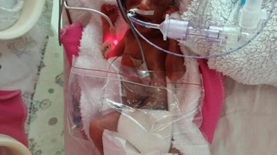 710 gram doğan Arden bebek, hayata nasıl tutundu?