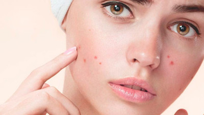 Bitki bazlı besinler akne ve lekeye neden oluyor