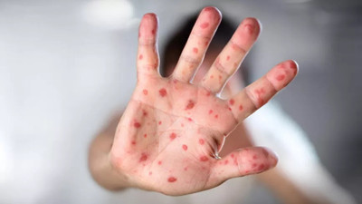 Kızamık salgını milyonlarca çocuğu öldürebilir. DSÖ’den korkutan uyarı