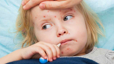 Biri bitmeden diğeri başlıyor bu seferki kabusun adı kızamık