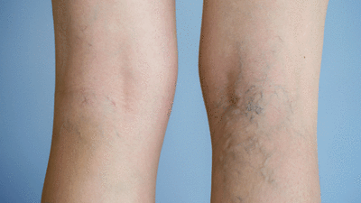 Damar tıkanıklığının ilk belirtisiymiş. Hemen kontrol edin