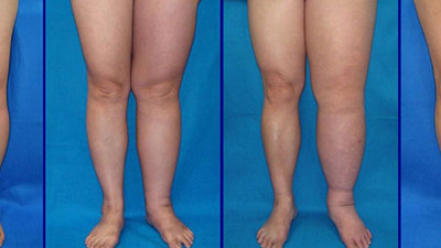 Fizyoterapistten fil hastalığıyla ilgili dikkat çeken uyarı