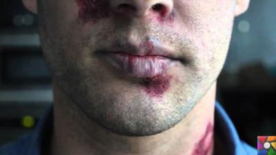 Türkiye’de günde 10 kişi HIV ile enfekte oluyor