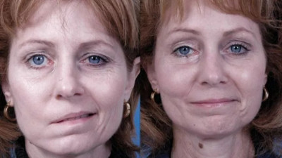 Mevsimi geldi yüz felcine dikkat