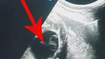 Yumurtalık kistleri hangi hastalığın habercisi?