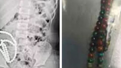 4 yaşındaki çocuğun karnından çıkanlar şoke etti. Midesinde 14’den fazla delik oluşmuş