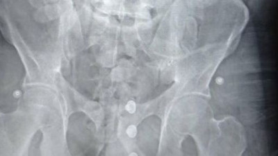 Faslı turistin midesinden çıktı. Polisler şaştı kaldı