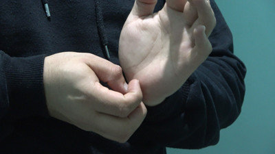 Uzmanından uyuz hastalığı uyarıları