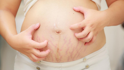 Gebelik çatlaklarından nasıl kurtulursunuz?