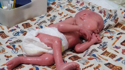 300 milyonda bir görülen 'yılan bebeğe' babası dava açtı! Dede kayyum olarak atandı