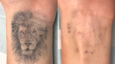 Yanlış dövme silmeleri tehlikeli