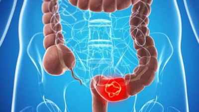 İşte Kolon kanseri ile ilgili her şey