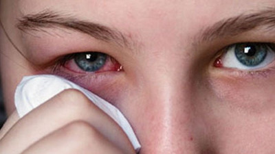 Göz kızarıklığı neden, nasıl olur? Göz kızarıklığının tedavisi nedir?