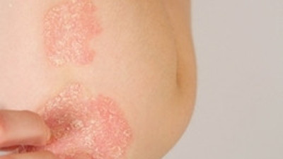 İşte Sedef hastalığından kurtulma yolları