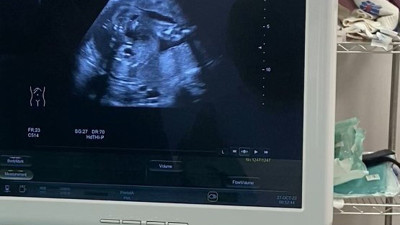 Anne karnındaki bebeğe mucize müdahale