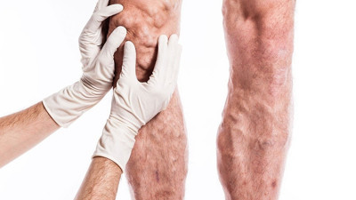 Uzmanı açıkladı. Varislerden ameliyatsız kurtulmak mümkün