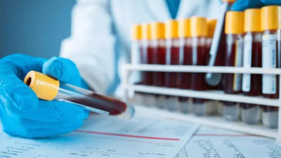 Bu kan grubuna ait olanlar yandı. Riski yüzde 51 daha fazla