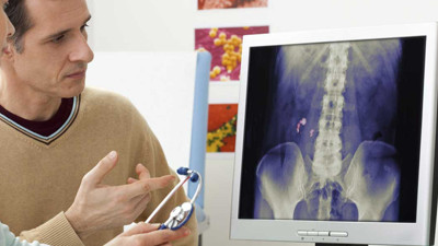 Uzmanından böbrek taşı hastaları için kritik öneri