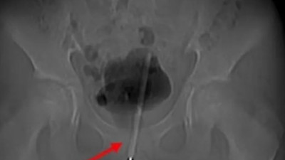 12 yaşındaki çocuğun penisinden çıktı. Doktorlar gözlerine inanamadı